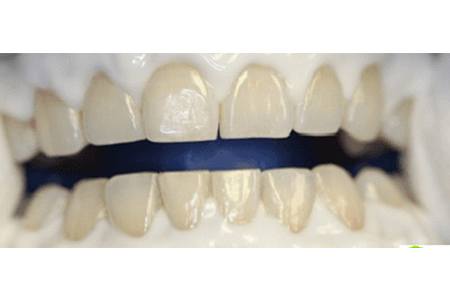 whitening using zoom whitespeed before image