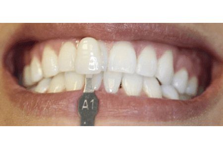 whitening using zoom whitespeed after image