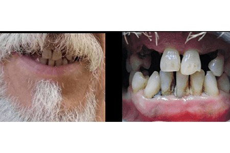 Dentures before Image