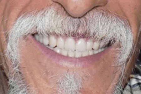 Dentures after Image