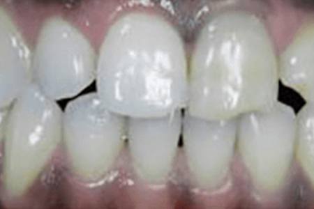 Before Chipped Anterior Image