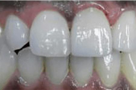After Crowns on #9 & #10 Image